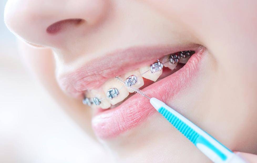 提前拆牙套对牙齿的影响有什么