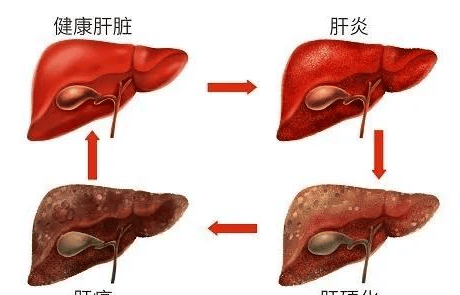 乙型肝炎跟糖尿病也有关