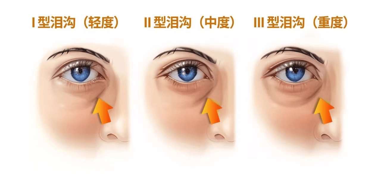 纳俊蓉医生分享眼周松垮塌到底是泪沟眼袋还是卧蚕