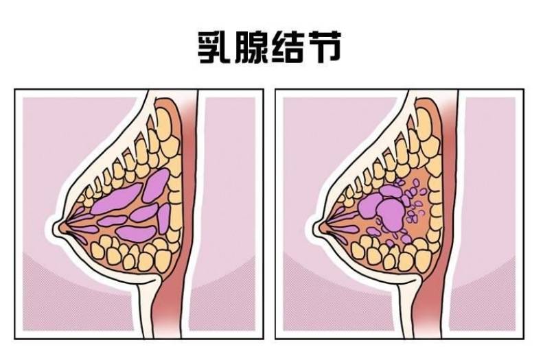 杭州新城妇儿医院教你怎么判断自己有没有乳腺结节