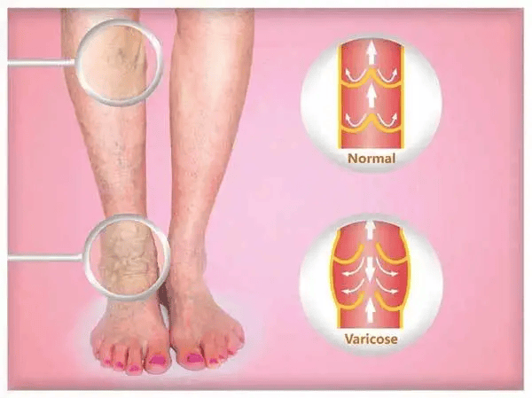 治疗静脉曲张手术需要多少钱 陕西冶金医院血管外科_下肢_患者_症状