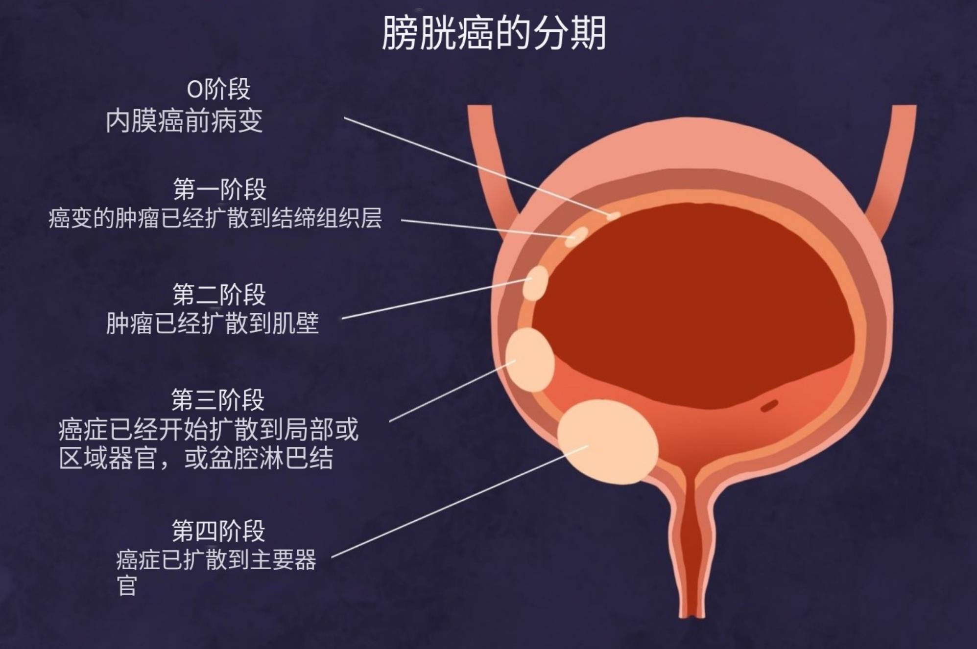 膀胱良性肿瘤图片