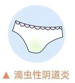 女性患滴虫性阴道炎有什么症状?杭州新城妇科医生解读