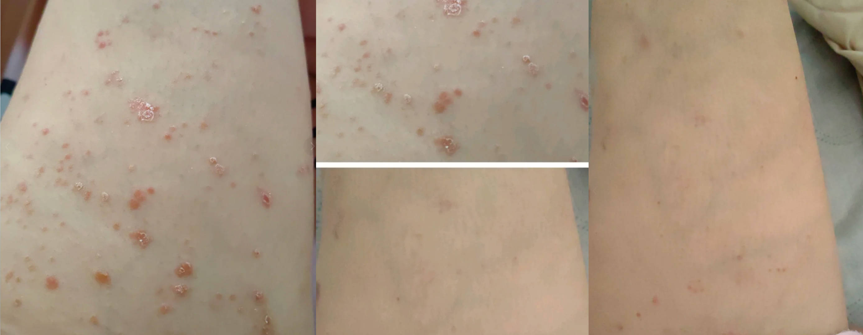 湿疹是"鬼门"打开了,想治好就存下吧!