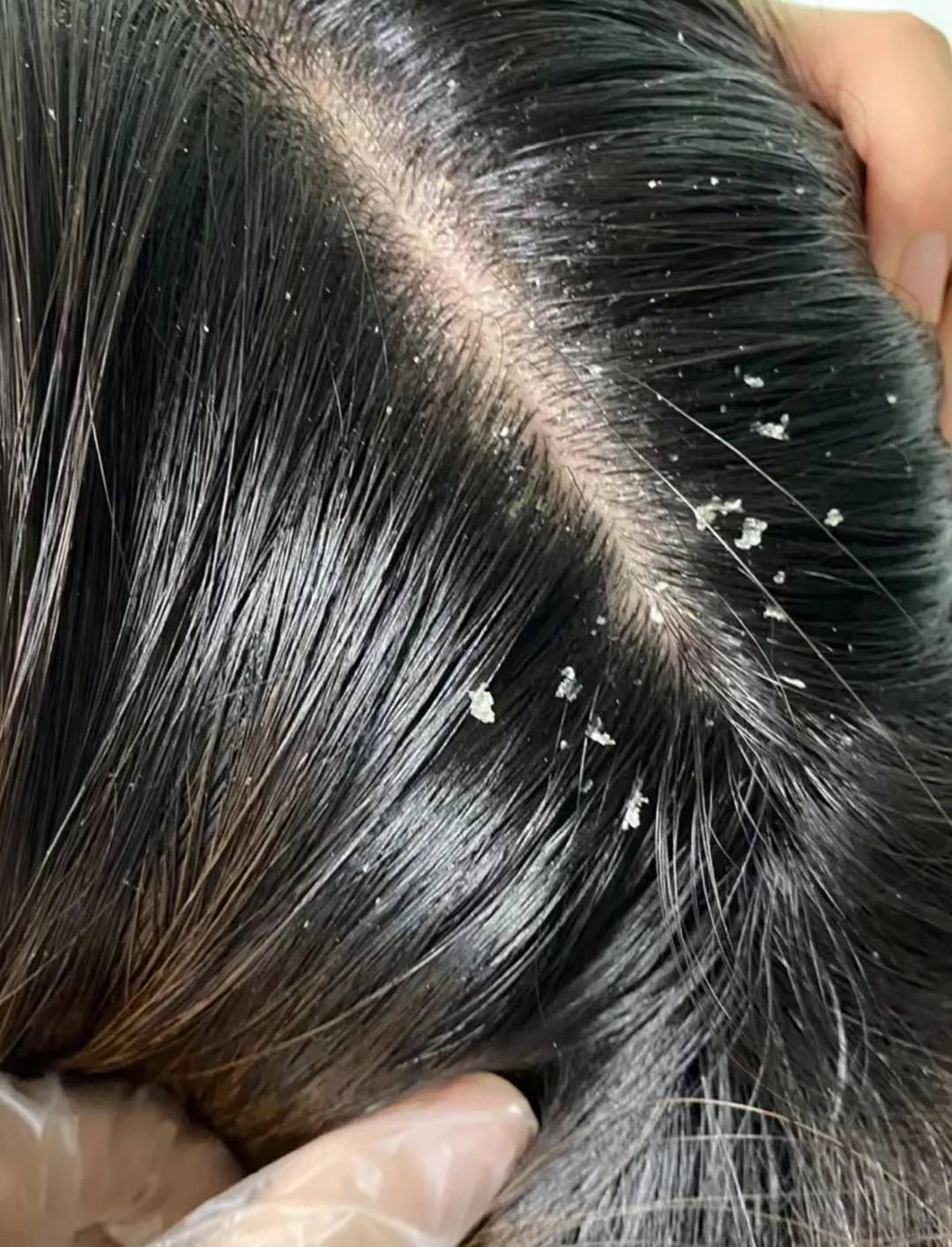 人为什么要长头屑啊?