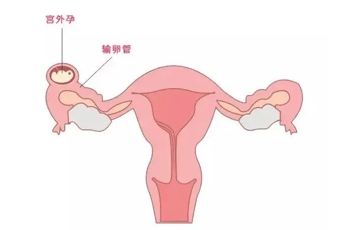 红木坊的朱秀英医生:为什么会发生宫外孕？这些因素你都要注意！_输卵管_受精卵_风险