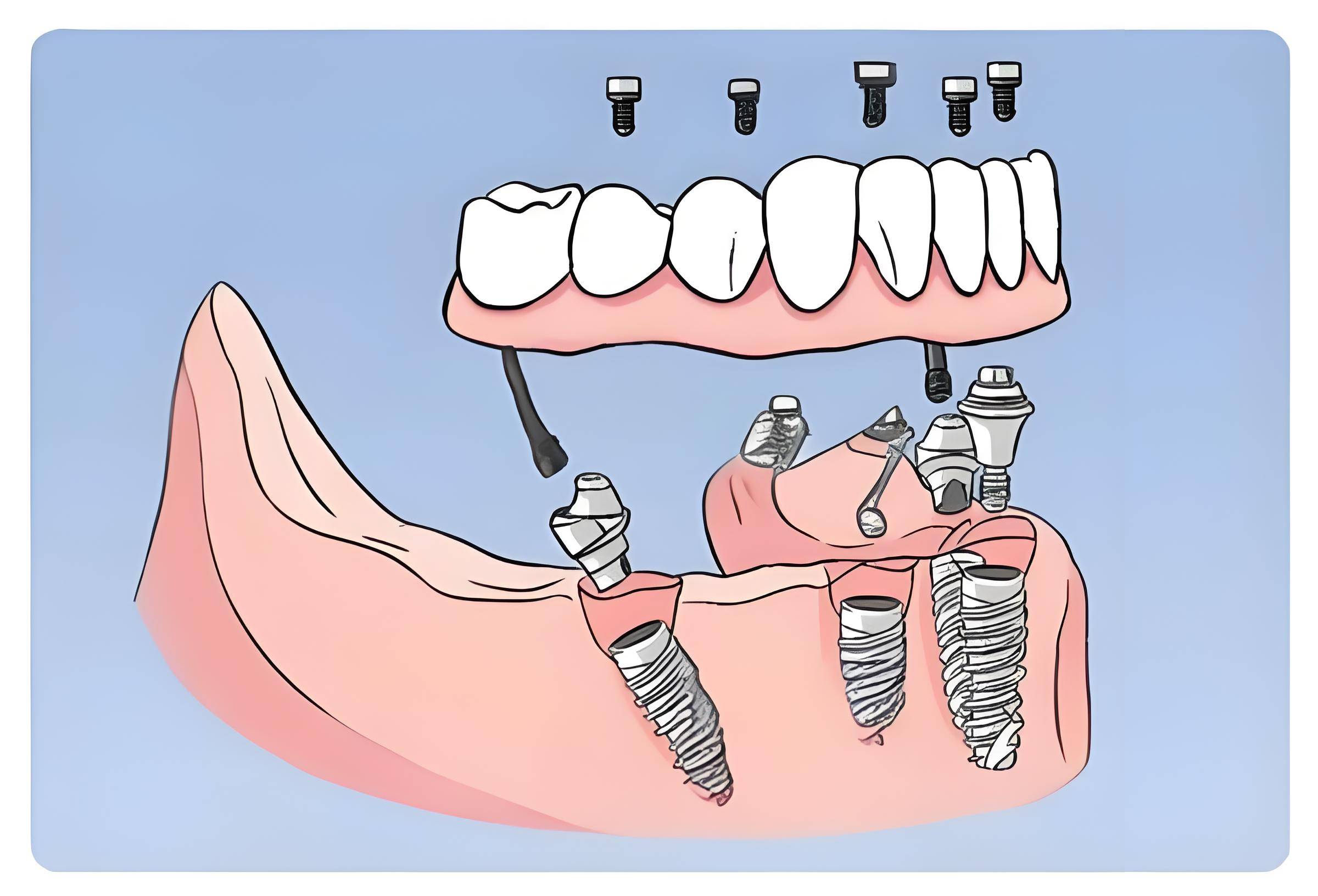 高血糖患者,需要在种植牙前进行综合评估,确保能够耐受手术过程