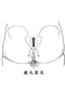 藏毛窦早期 症状图片