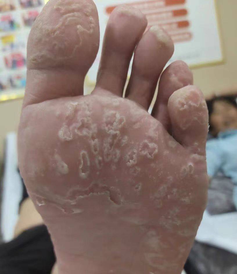 脚部真菌感染的症状图片