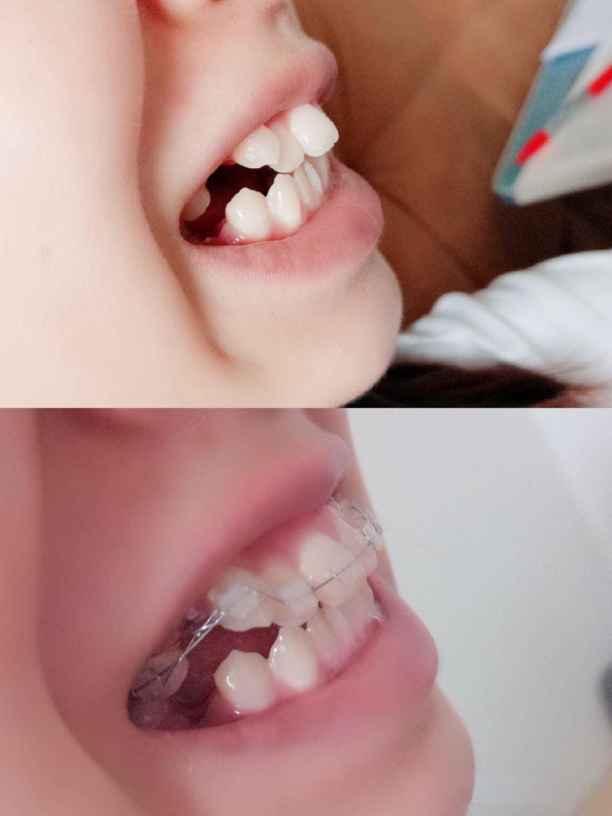 邢台牙齿矫正需要多久恢复?