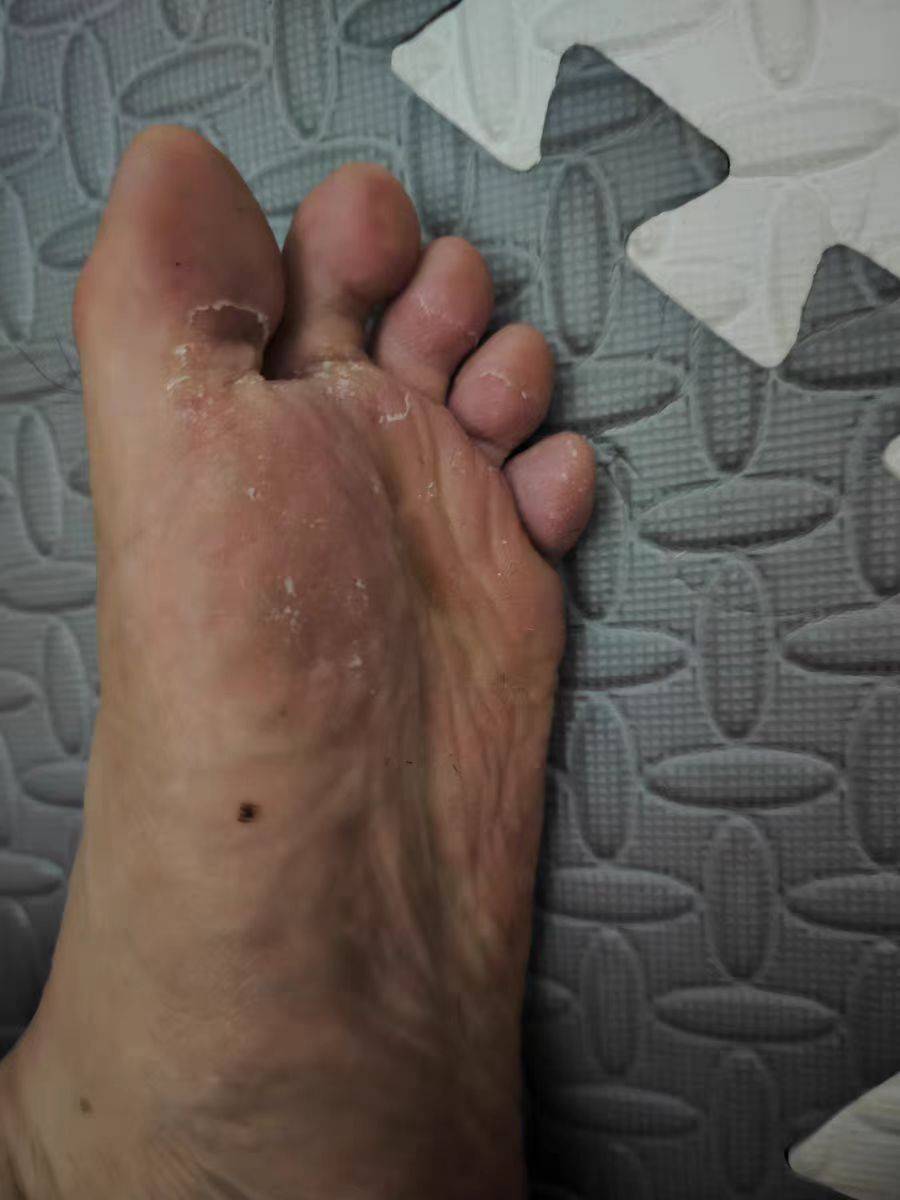 脚上水泡又臭又痒?超全的脚气产品真实测评,跟着选脚气就没了!