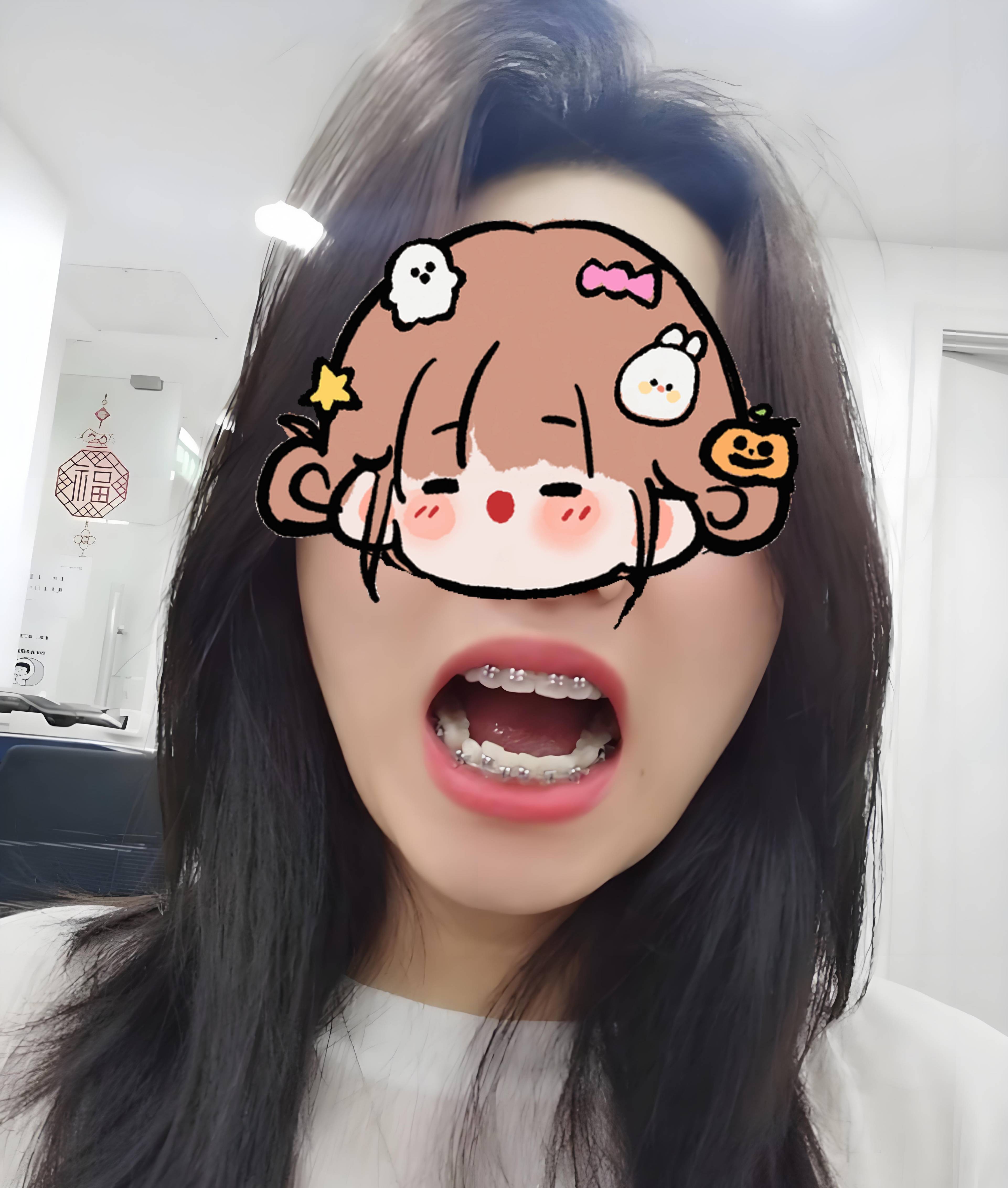 二次矫正有必要吗?邢台整牙,矫正牙分享