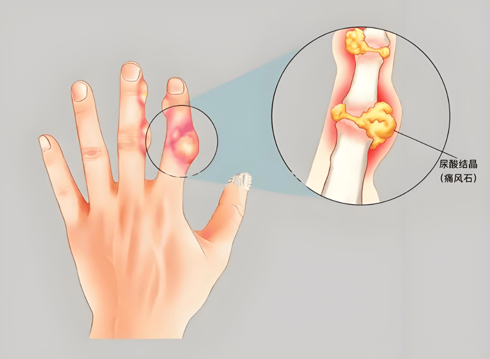 痛风恶化的4个征兆,有1个就要检查!