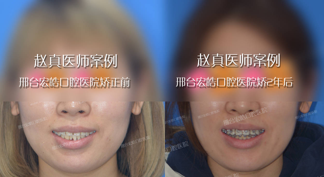 邢台29岁女孩矫正牙齿20个月，效果堪比整容-小女孩矫正牙齿
