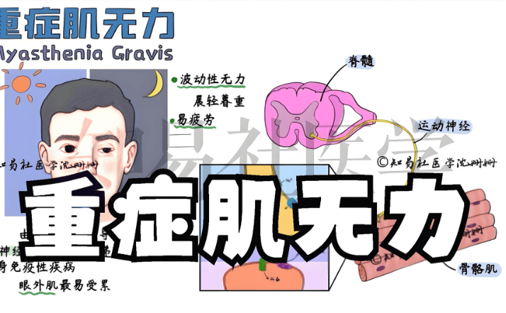 重症肌无力:挑战与希望并存的神经肌肉疾病