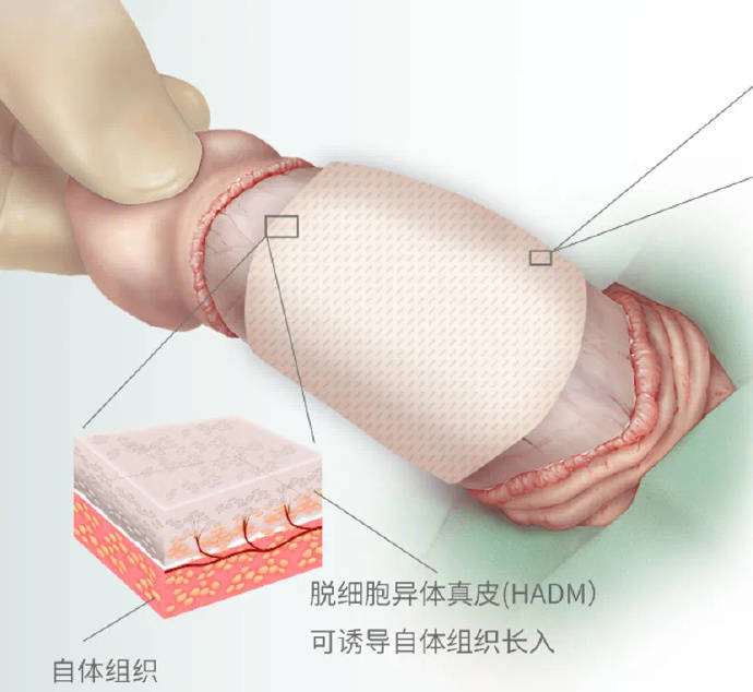 生物补片增粗的手术已经成熟,但是做了之后会影响性感觉吗?