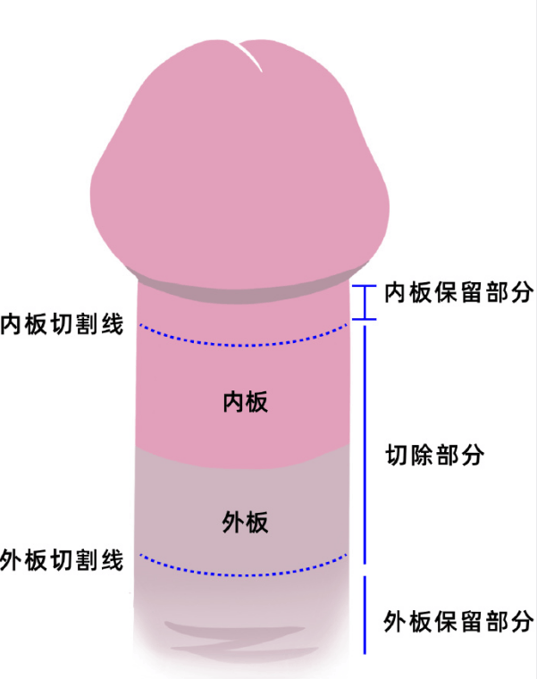 什么是系带撕裂?