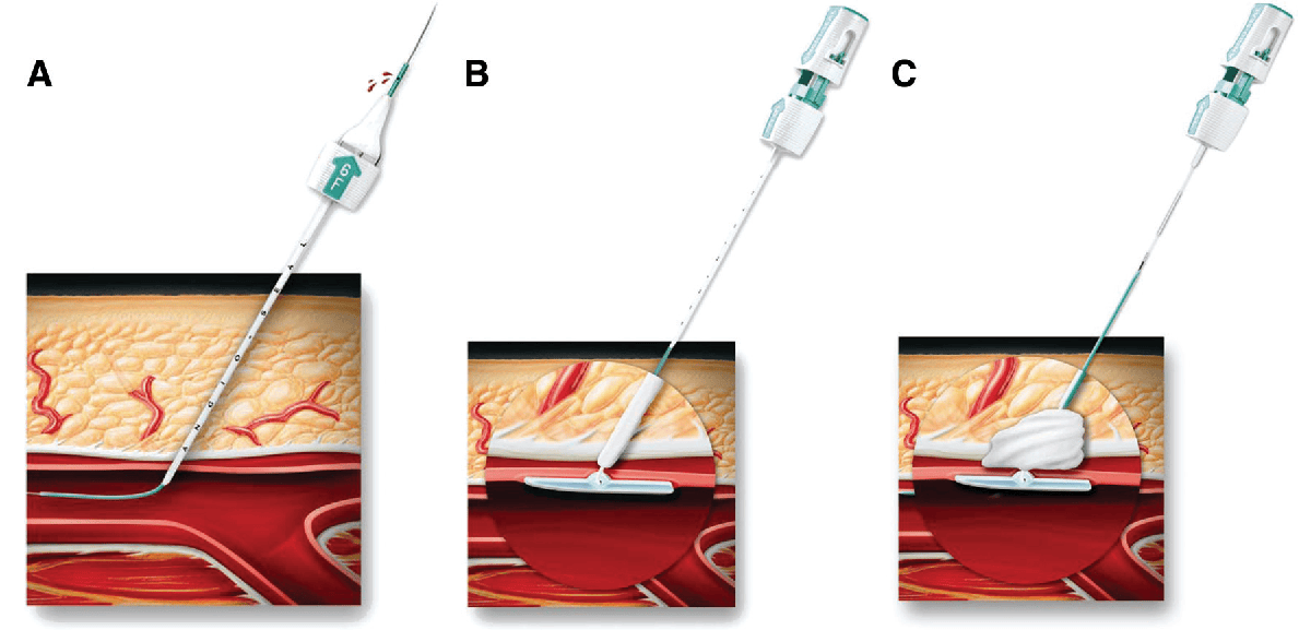 行业研究|盘点5种血管封堵器_闭合_exoseal_定位器