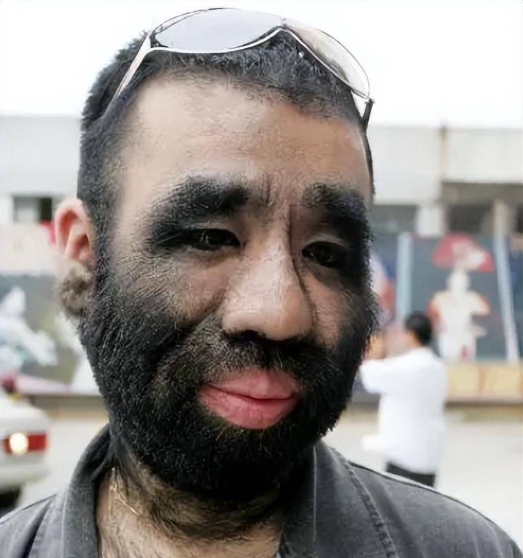 当年轰动一时的"毛孩":42岁娶90后娇妻,生下一子未遗传长毛