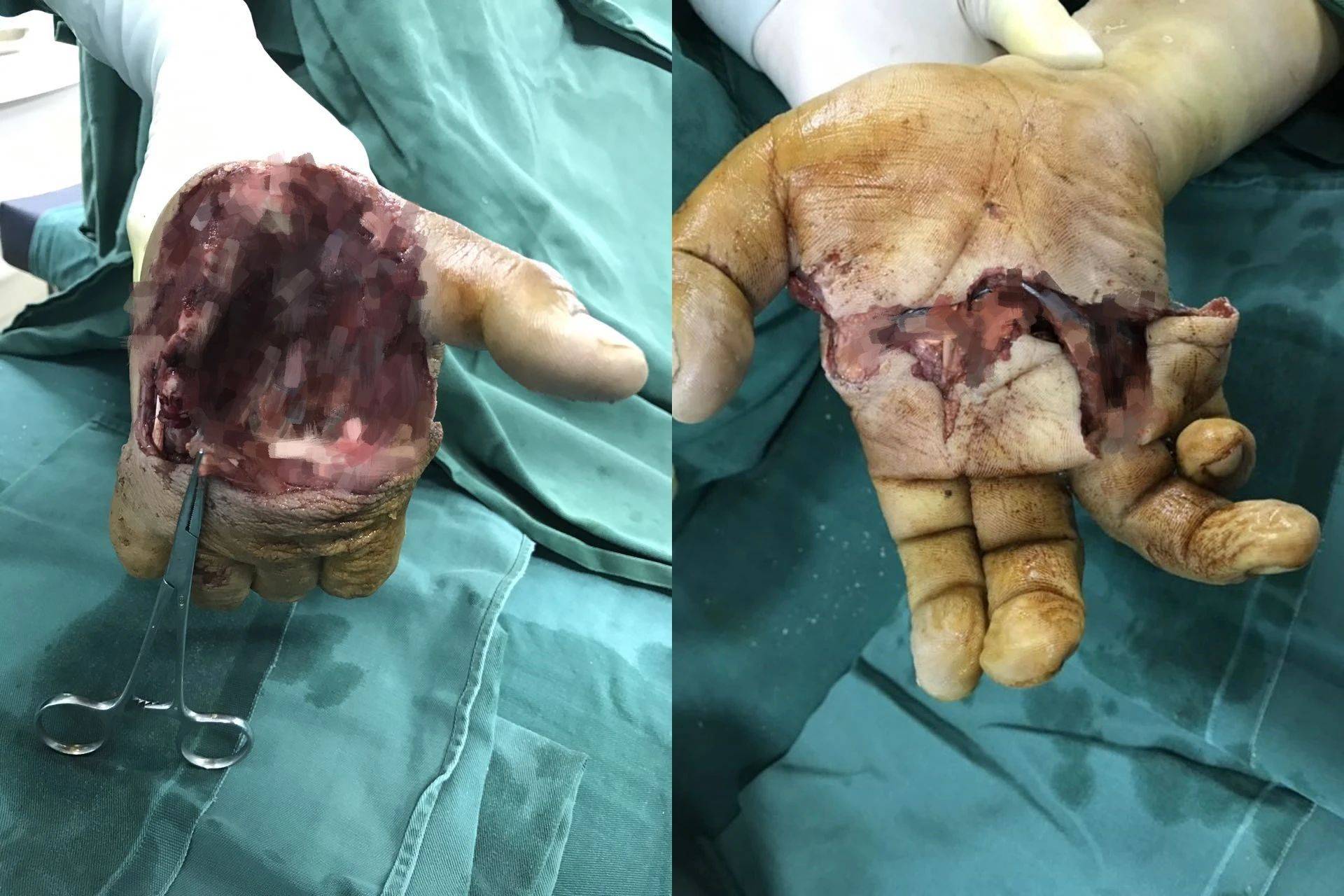 【病例分享】大肢体离断及时送医,不必成为"独臂大侠"!