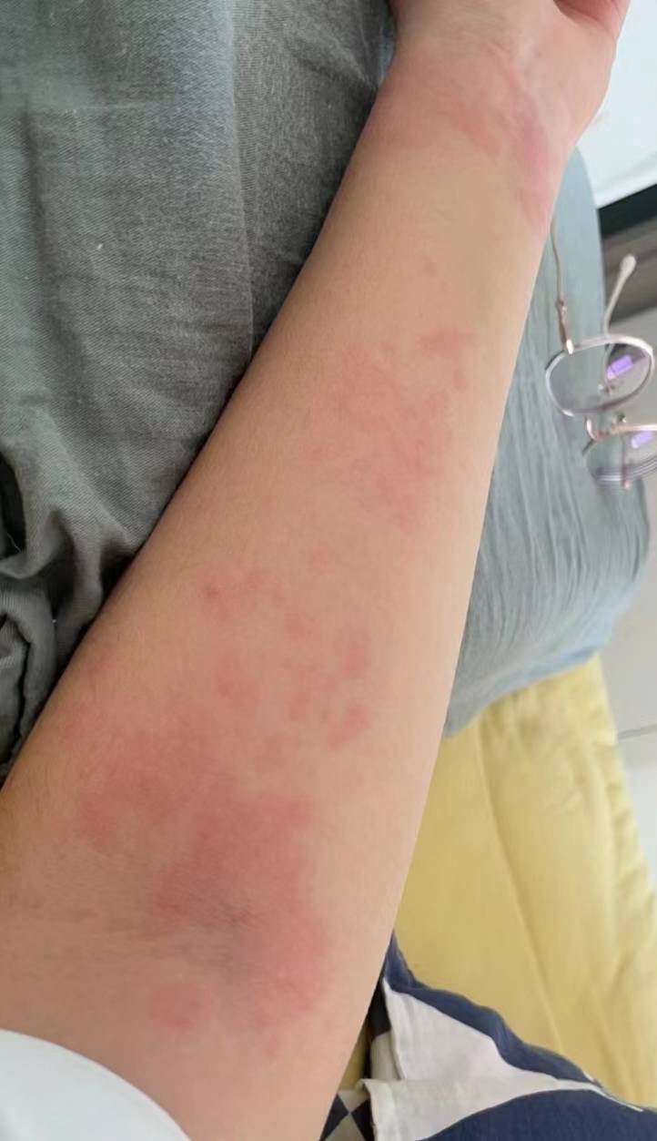 自用真实去湿疹大测评,跟着过来人走不会错!_效果_才控_症状