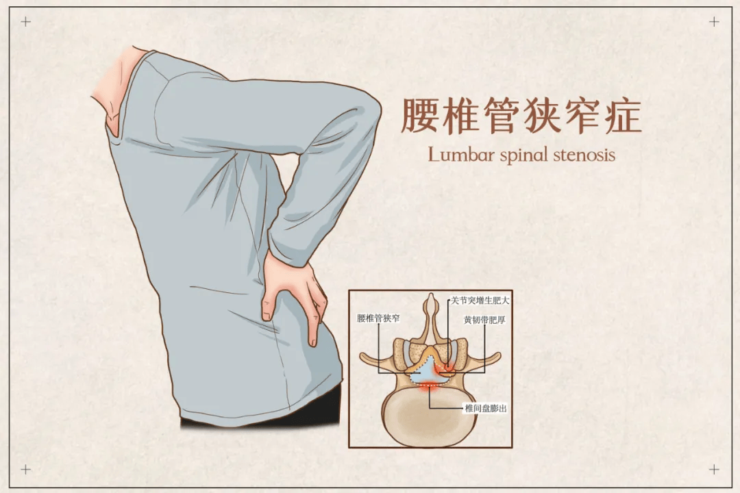 昆明同仁医院骨科 经常腰腿痛要警惕腰椎管狭窄症