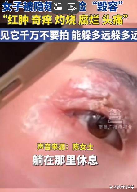 原创            女子把隐翅虫当蚊子拍死差点毁容-隐翅虫被拍死
