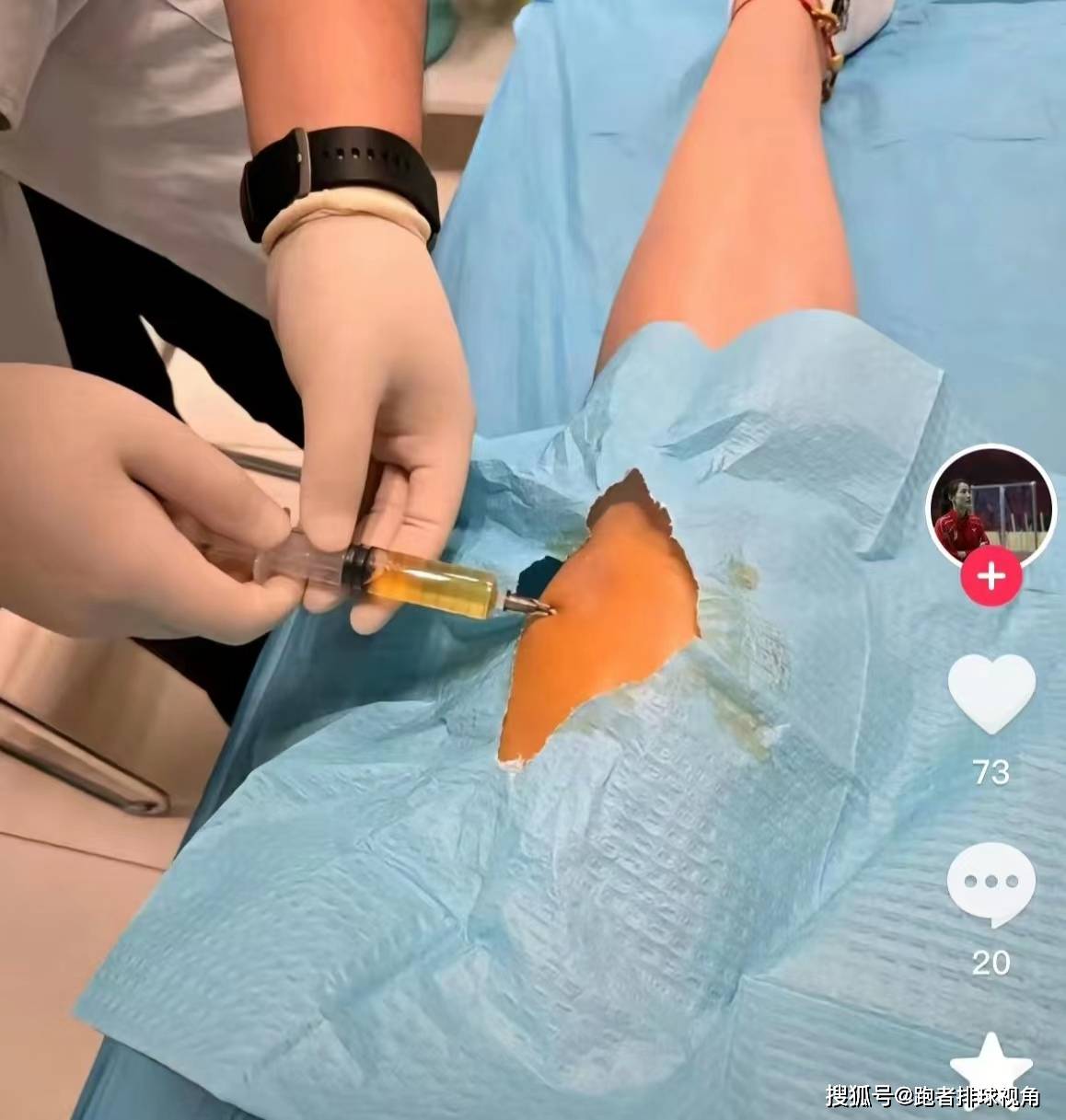 中国女排坏消息!刁琳宇伤病严重,膝盖抽出大量积液,让人心疼