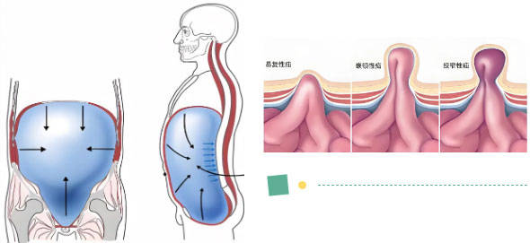 半月线疝修补方法图片图片