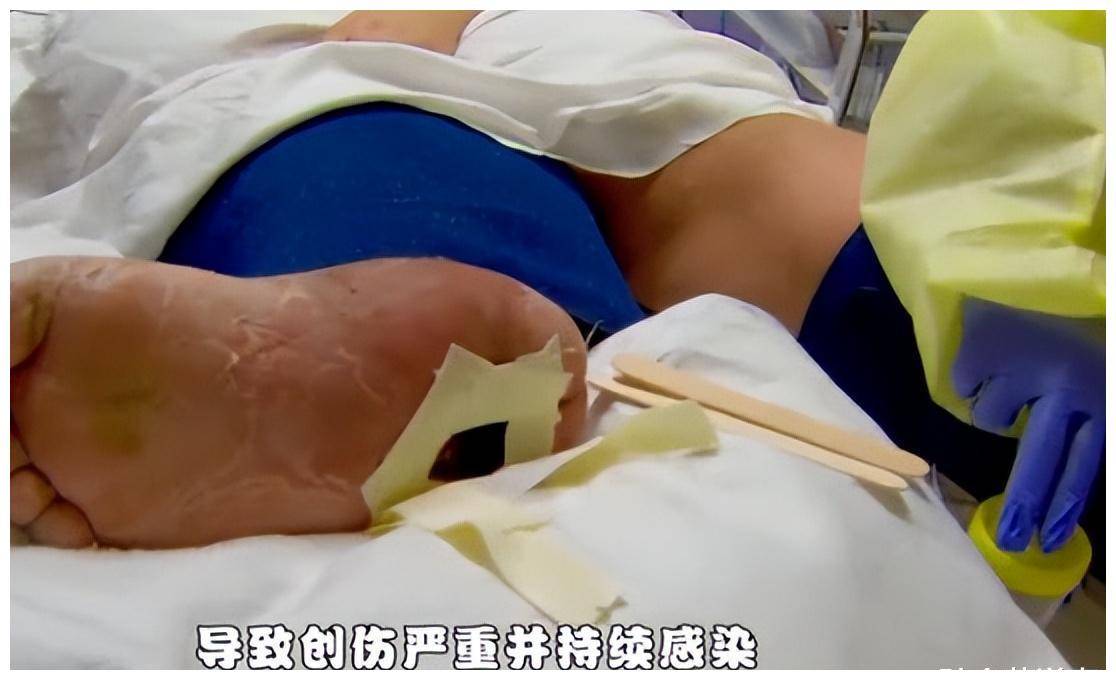 只不过后来青霉素这一类的抗生素出现了,蛆虫疗法也就随之被取代