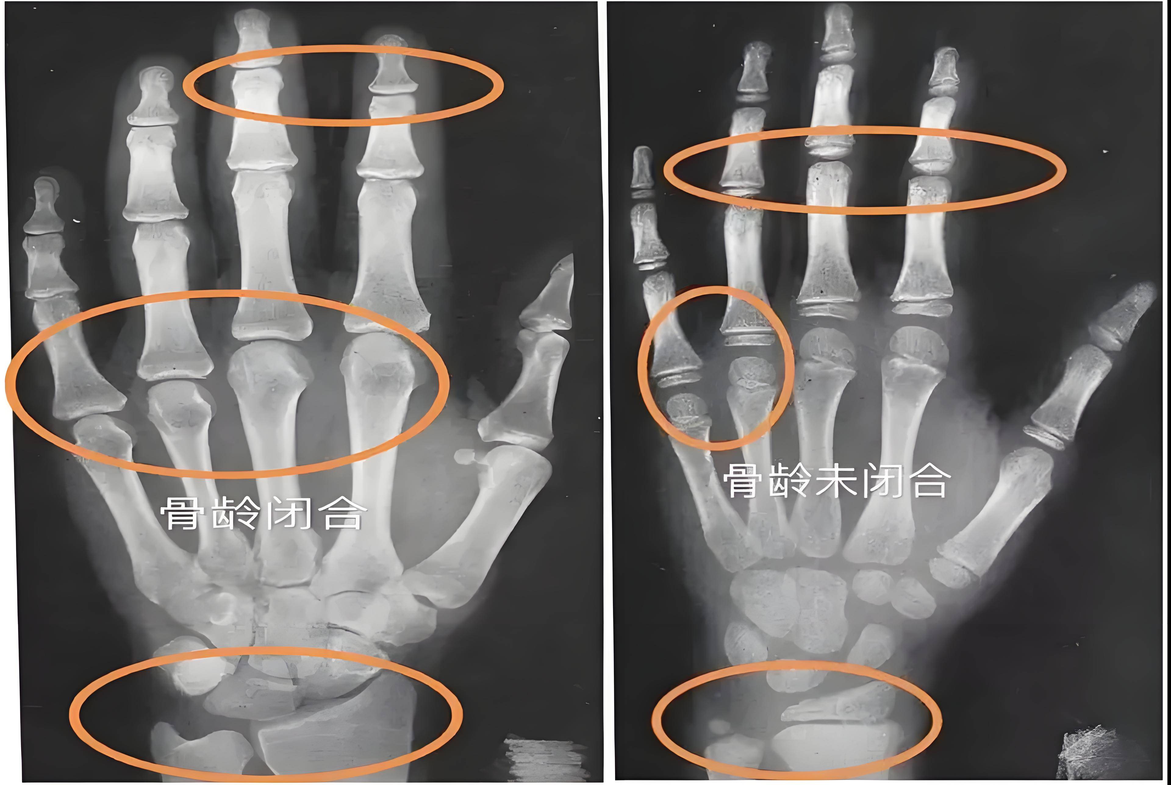 骨龄超前:孩子身高的隐形"拦路虎",定期检查为您守护成长每一步!