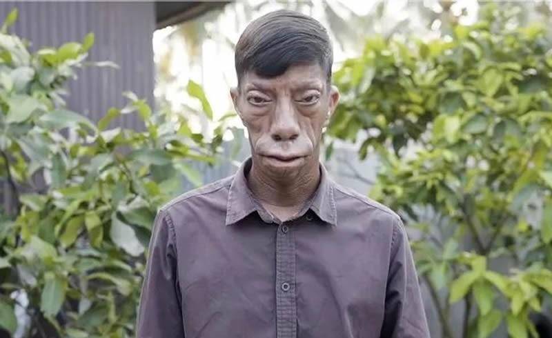 印尼4兄妹患罕见怪病,长着一张"动物"的脸,酷似三星堆面具