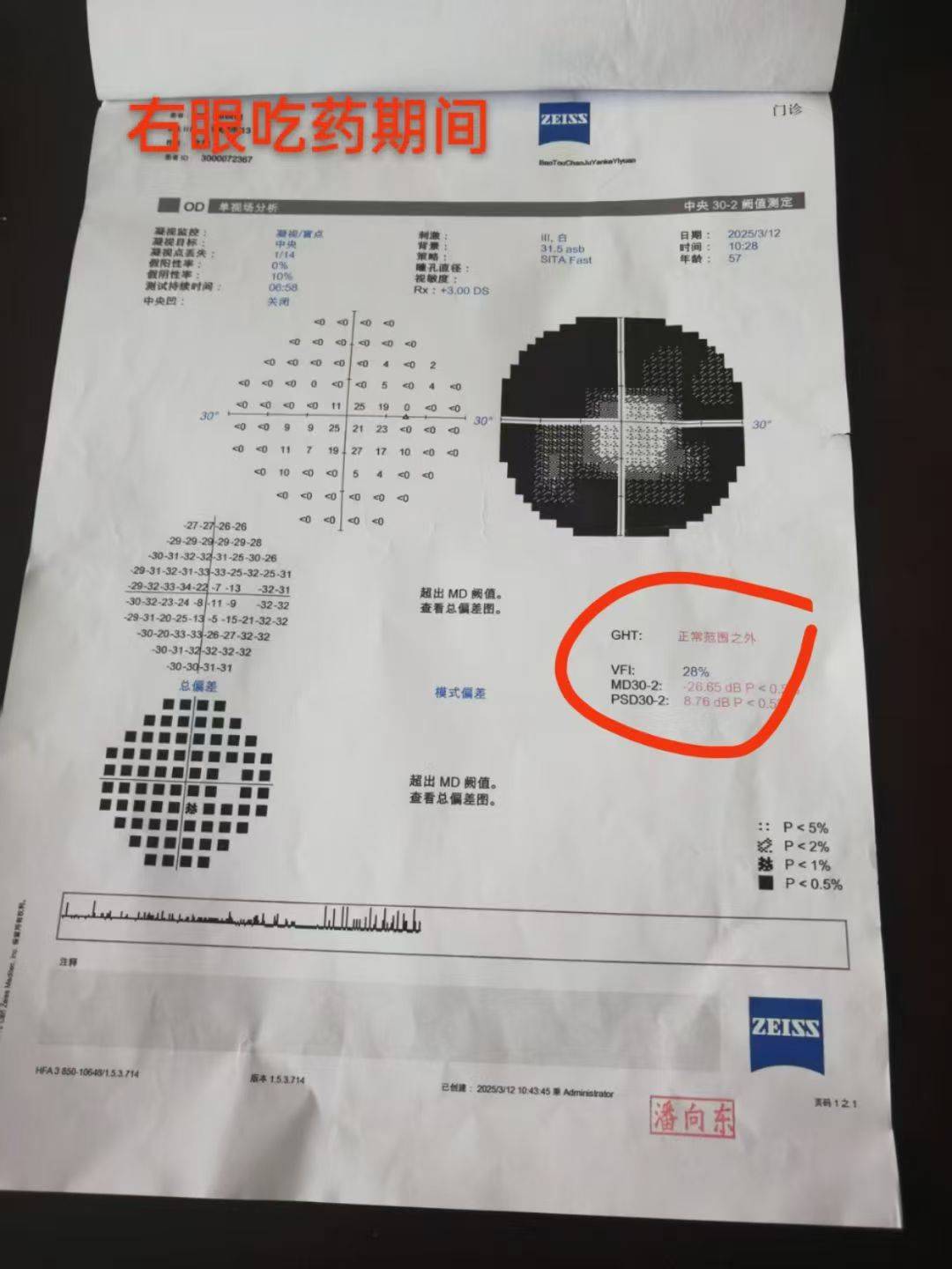 青光眼视神经萎缩患者