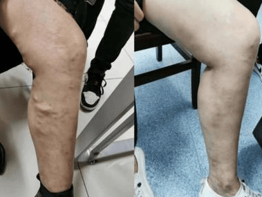 真没想到能这么快治好静脉曲张