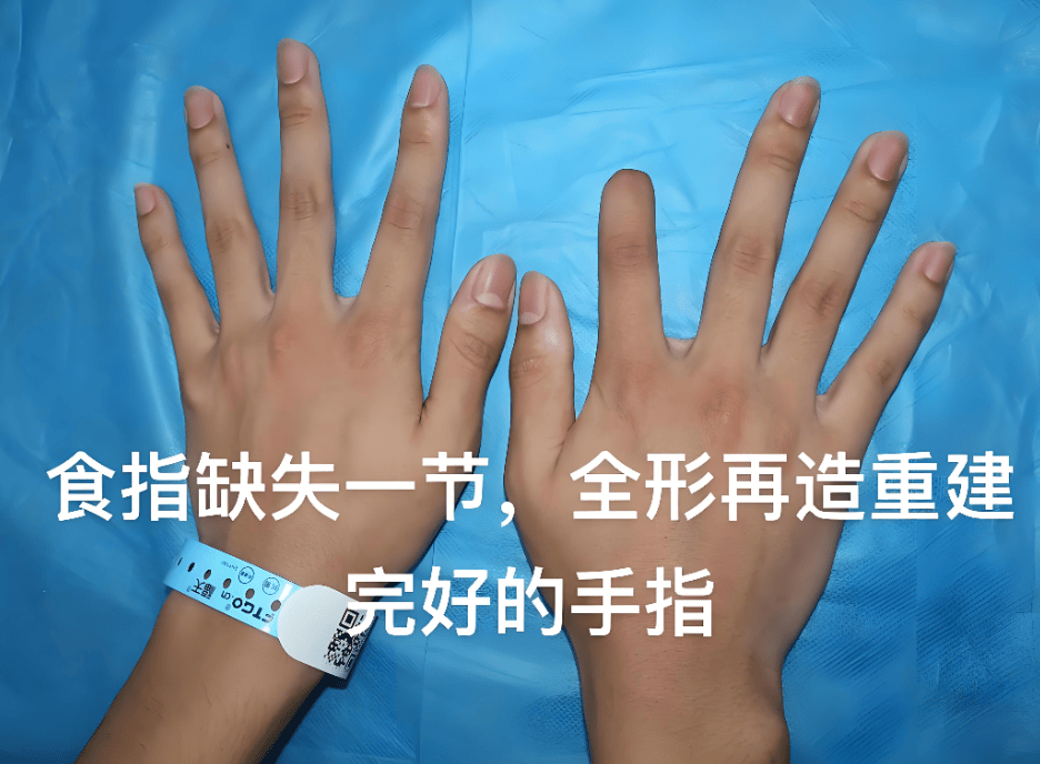 断指患者请看过来，手指再造技术的做精、做细、做强