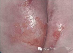 失禁性皮炎?压疮?两者怎么鉴别?_皮肤_损伤_压力