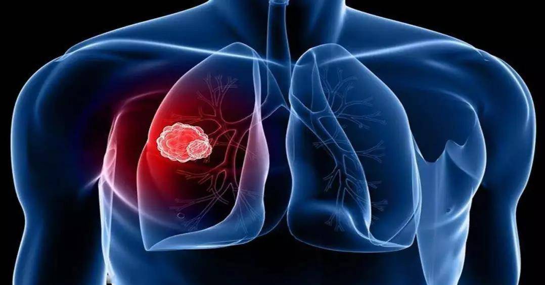 浙江大學最新研究:發現非小細胞肺癌潛在治療策略_激酶_癌症_機制