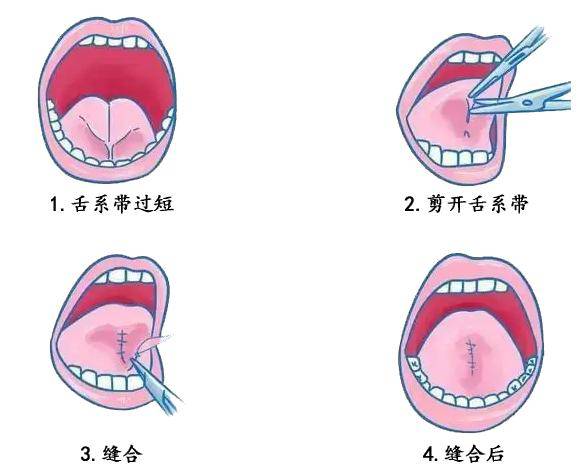 怎么判断舌系带图片