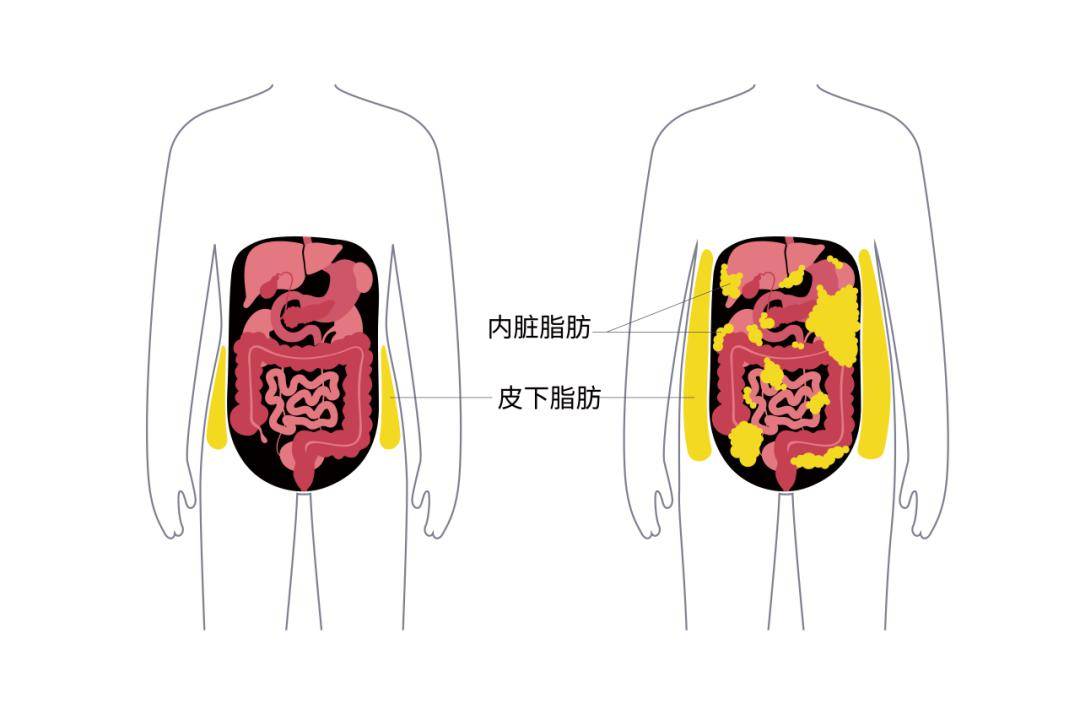 内脏脂肪和皮下脂肪图图片