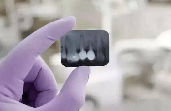 看牙为什么要拍片?这应该是我听过最好的理由!_牙齿_口腔_辐射