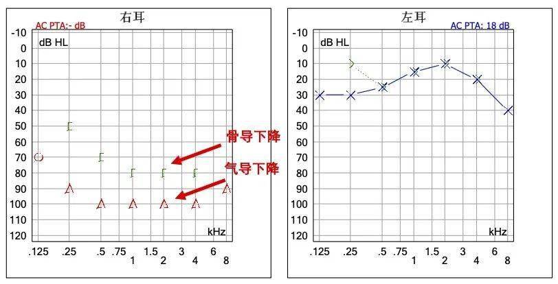 电测听标准正常图图片