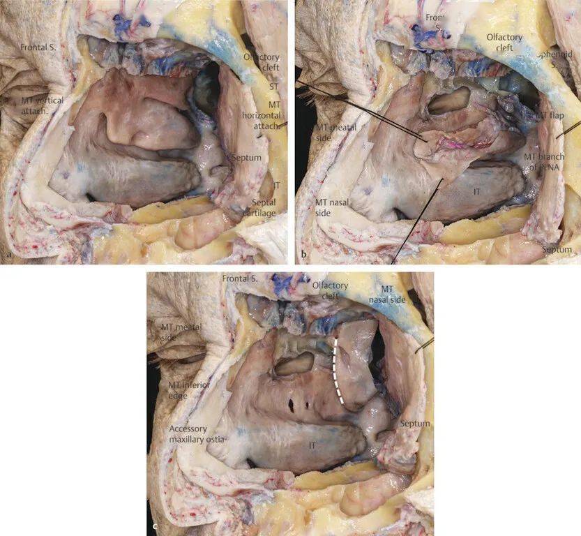 thieme解剖 | 鼻中隔粘膜瓣等 - 内镜颅底重建之4_the_flap_points