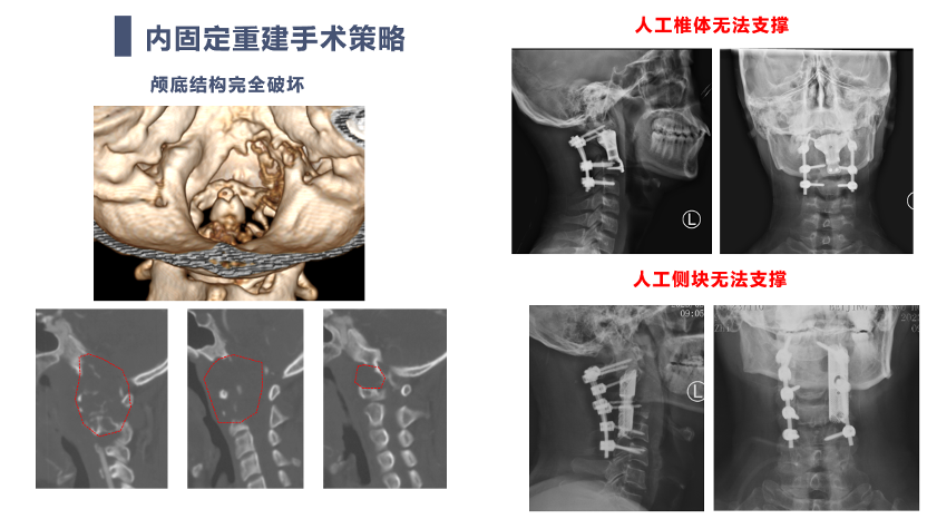 宣武有術|後路聯合極外側入路顱頸交界脊索瘤切除 頸椎四棒系統固定