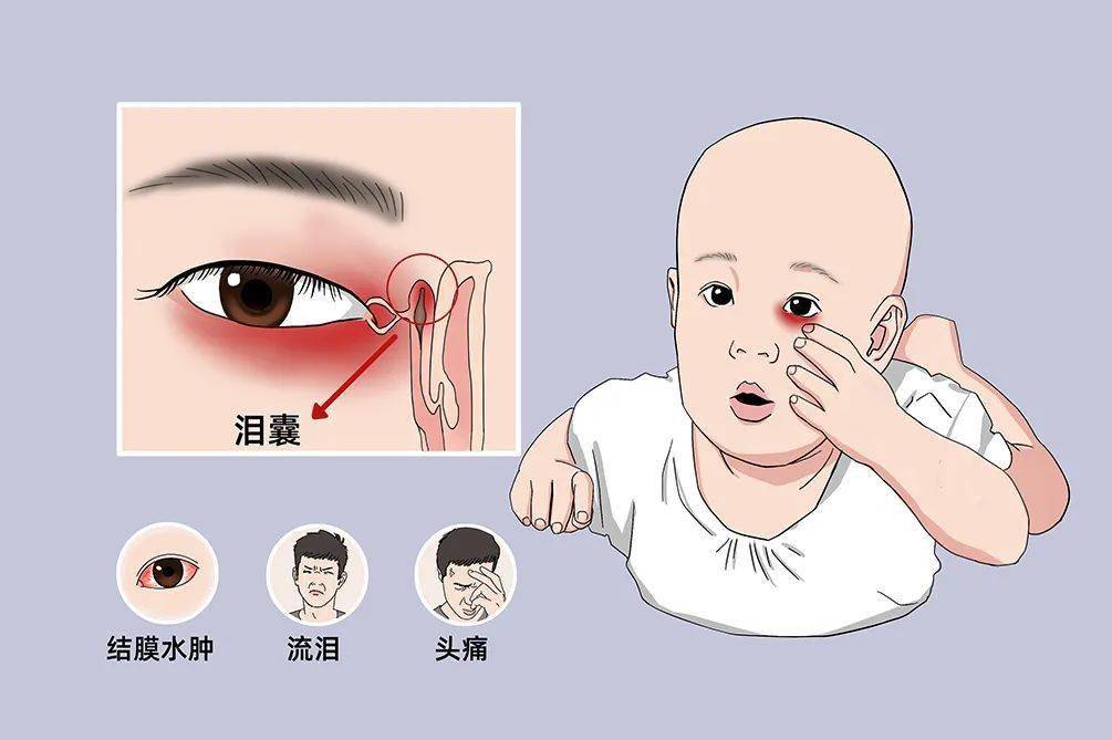 导致泪水分泌增加,或者泪道因疾病阻塞,泪小点位置异常和"泵"功能减退