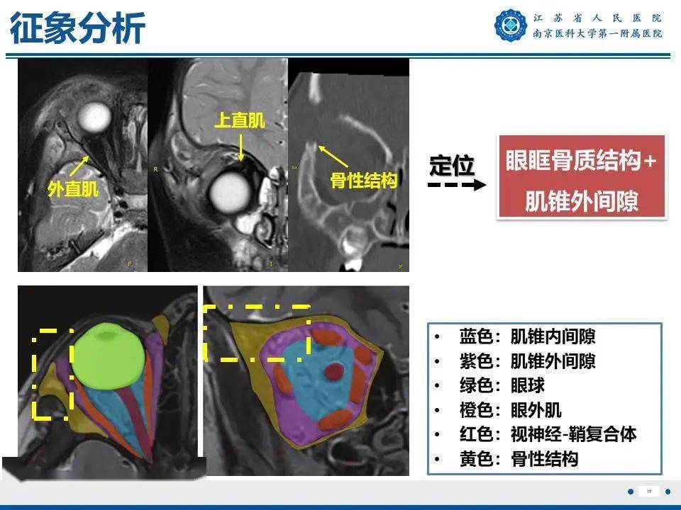 眼眶朗格漢斯細胞組織細胞增生症——破骨而出_全網