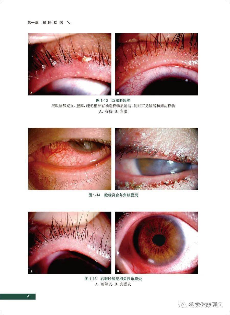 《眼部裂隙灯生物显微镜图谱》《眼前节疾病裂隙灯图像解读》