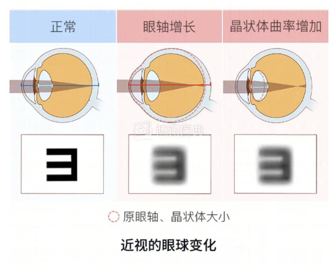 近视眼与正常眼睛外观图片