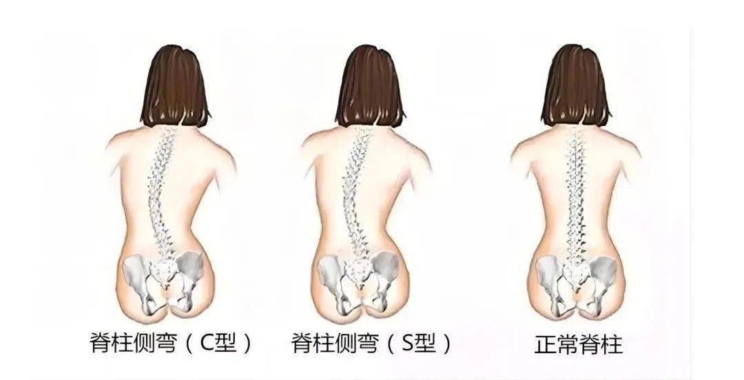 後背疼痛,高低肩頭頸疼痛總是落枕寫作業坐姿往一邊歪