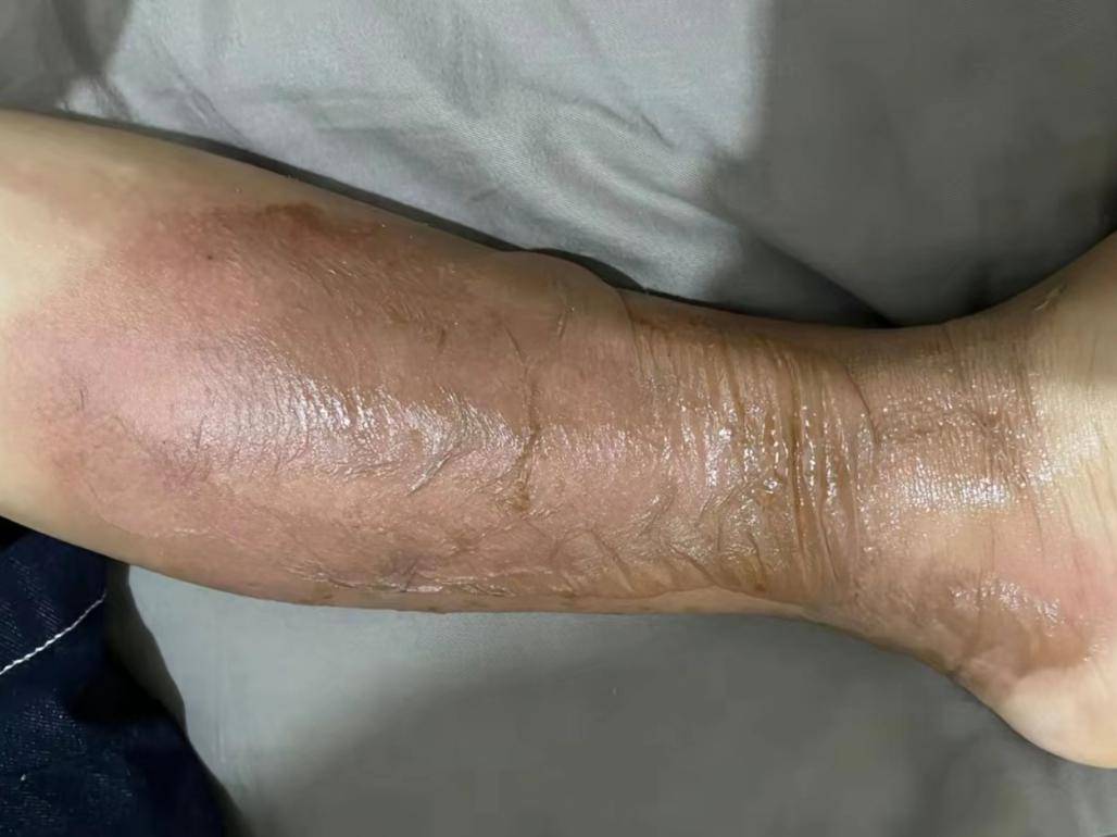 付向荣主任讲外科|烧伤的诊断与应急处理_损伤_皮肤_进行