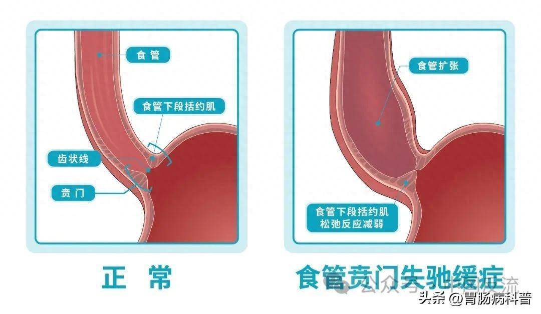 贲门口松弛图片